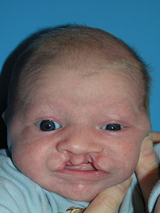 Bilateral Cleft Lip 1