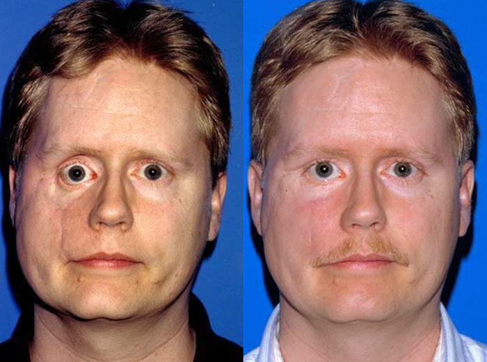Post-Traumatic Facial Deformities 12