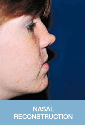 nasal reconstruction