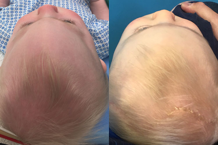 trigonocephaly