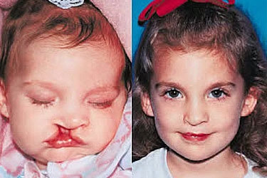 clefts-of-the-lip-and-palate-px