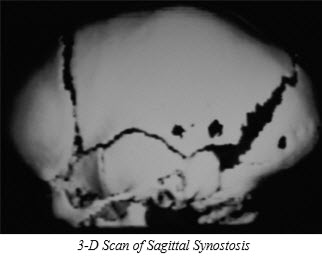 Craniosynostosis