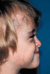 Apert Syndrome 10