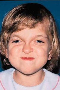 Apert Syndrome 8