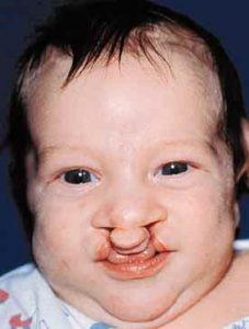 Bilateral Cleft Lip 3