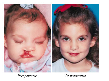 Clefts of the Lip and Palate