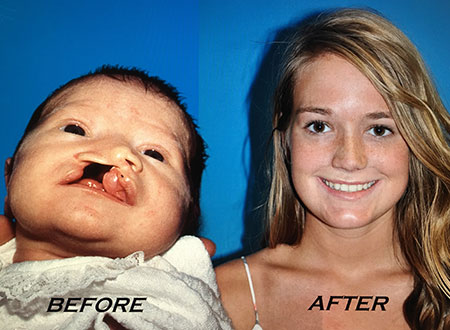 Unilateral Cleft Lip Repair 9