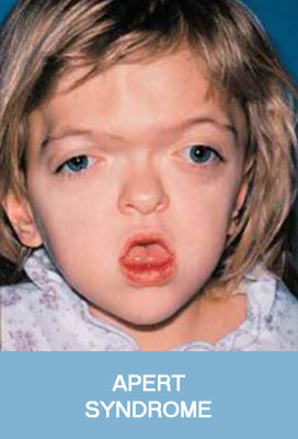 apert syndrome