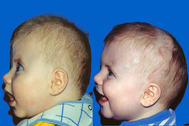 Bicoronal Craniosynostosis 1