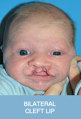 bilateral cleft lip