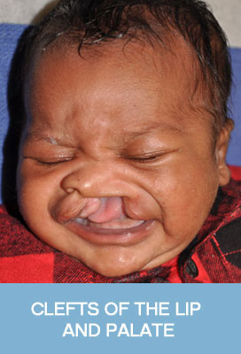 Clefts of Lip and Palate