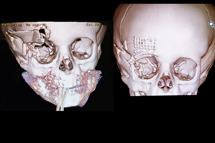 orbital fracture patient