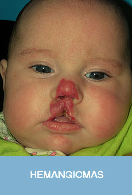 hemangiomas