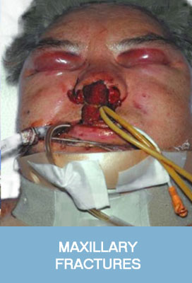 maxillary fractures