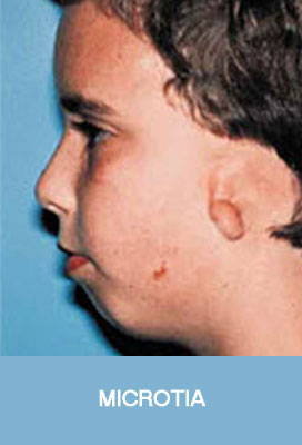 microtia