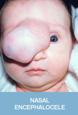 nasal encephalocele