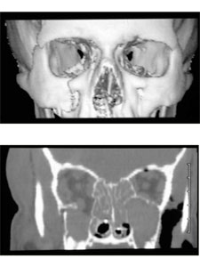 Orbital Fractures 6