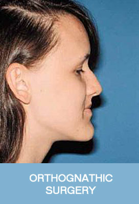 orthognathic surgery