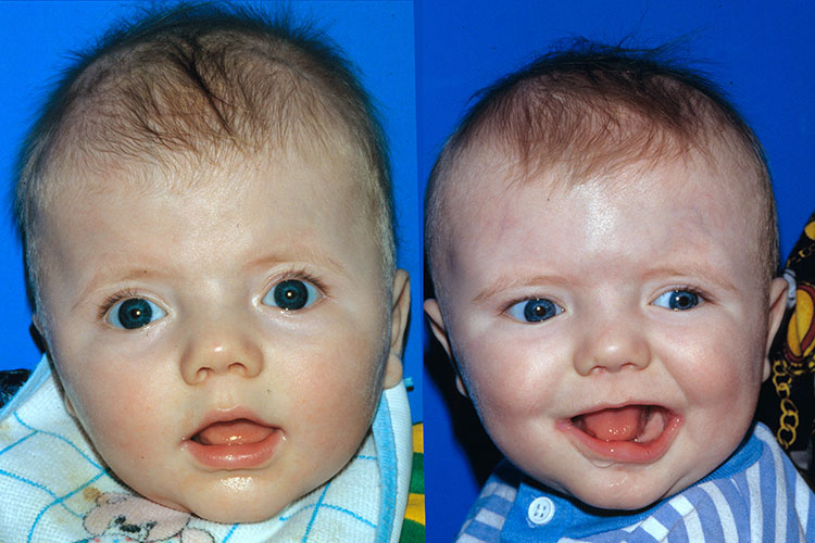 Craniosynostosis