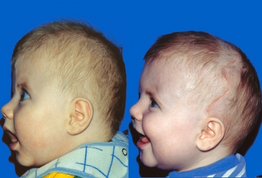 Bicoronal Craniosynostosis