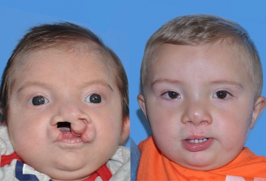 bilateral-cleft-lip-01