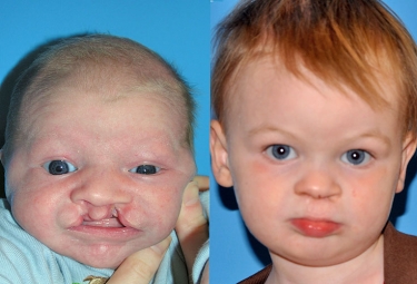 bilateral-cleft-lip-02