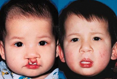 bilateral-cleft-lip-03