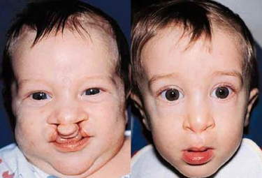 bilateral-cleft-lip-04