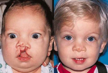 bilateral-cleft-lip-05