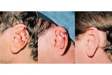 Traumatic-Ear-Deformities_p1