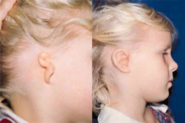 microtia_p1