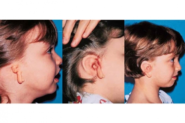 microtia_p3