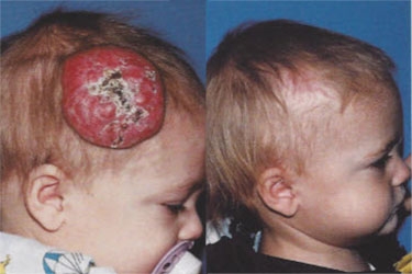 hemangiomas-04