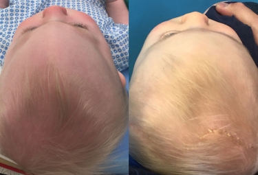 trigonocephaly-01