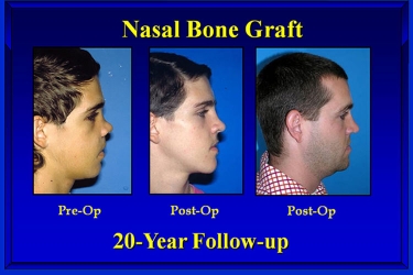nasal-reconstruction-03