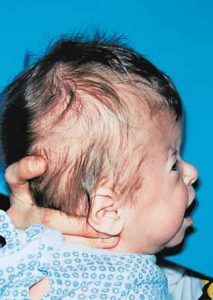 Apert Syndrome 3