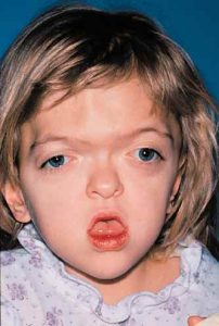 Apert Syndrome 7