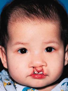 Bilateral Cleft Lip 1