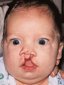 Bilateral Cleft Lip 5