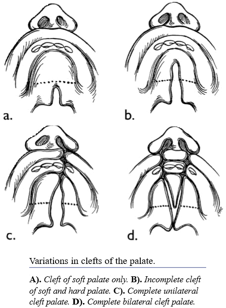 Clefts of the Lip and Palate