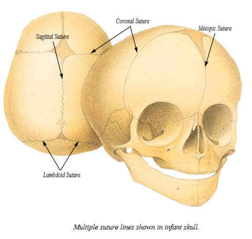 Craniosynostosis