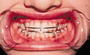 Orthognathic Surgery 16