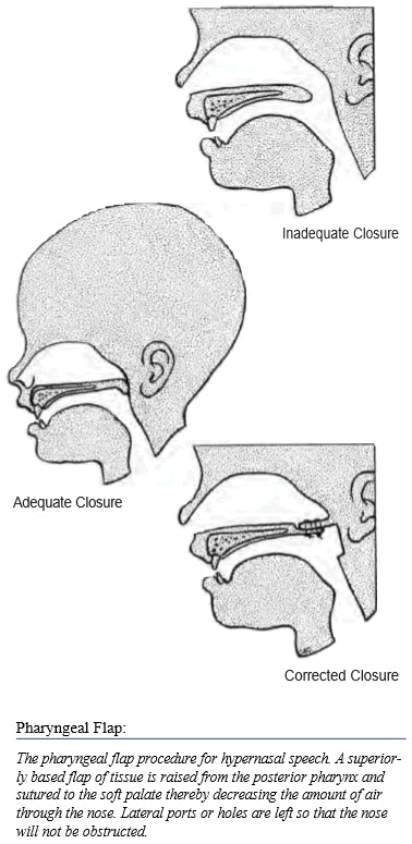 Pharyngeal Flap