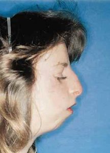 Treacher Collins Syndrome 3