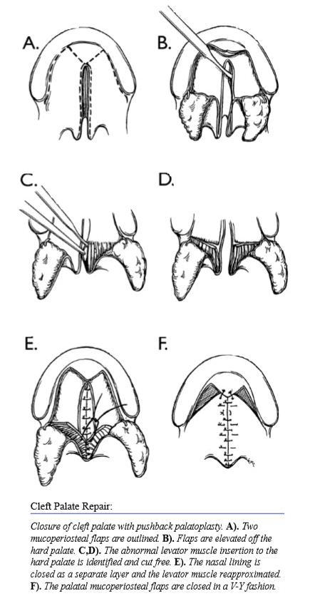 Cleft Palate Repair