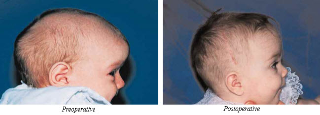 Craniosynostosis