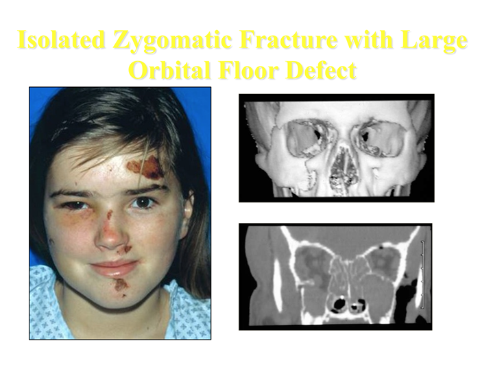 zygomatic arch fracture treatment